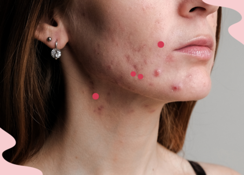 adult acne