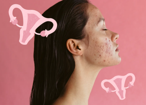 hormones and acne