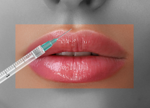 non-surgical lip lift