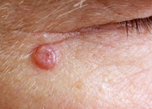 Basal Cell Carcinoma: What Patients Need to Know