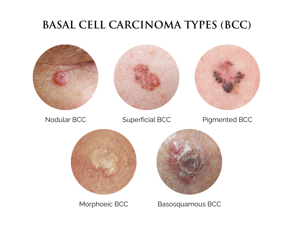 What Is Skin Cancer Basal Cell