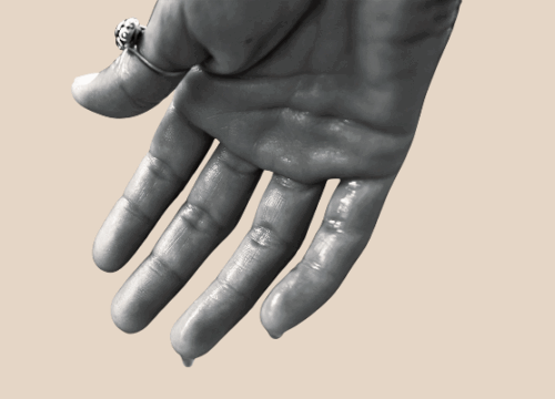 National Hyperhidrosis Month: Understanding and Treating Excessive Sweating